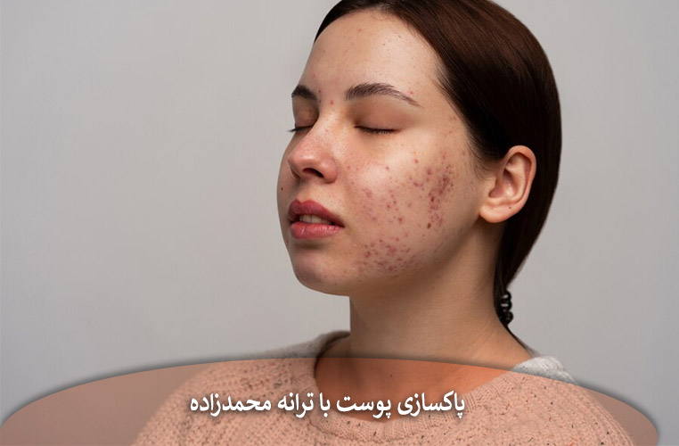 فیشیال ضدجوش ترانه محمدزاده