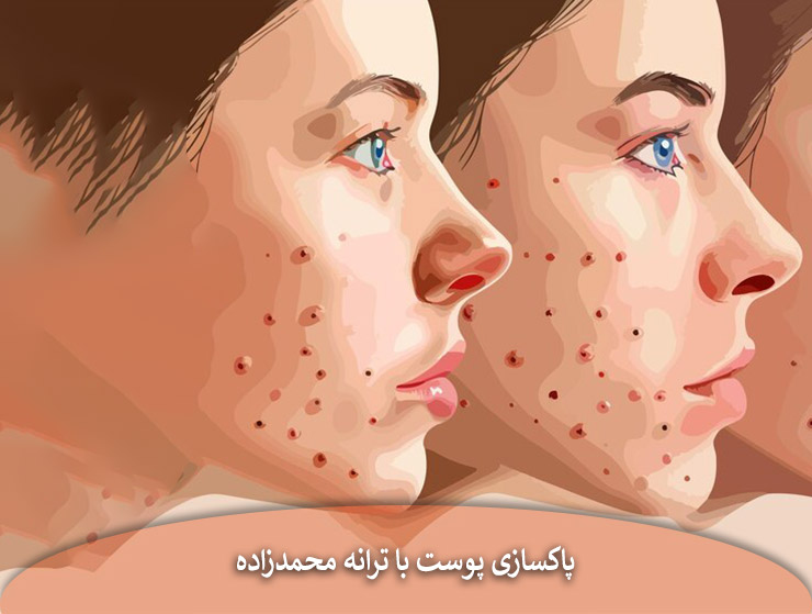جوش‌ سر سیاه و رفع آنها در آکادمی ترانه محمد زاده