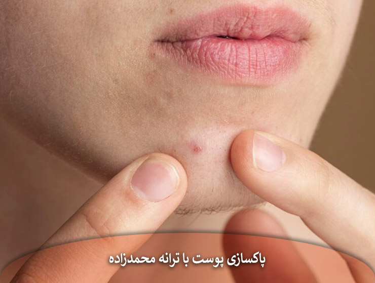 نحوه جلوگیری از جوش های سر سفید با ترانه محمدزاده