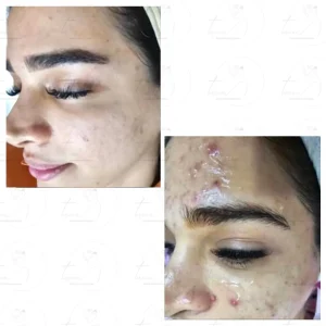 تصویر قبل و بعد درمان جوش سرسفید با ترانه محمدزاده