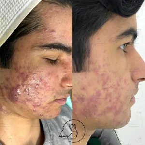 تصویر قبل و بعد درمان جوش سرسفید با ترانه محمدزاده