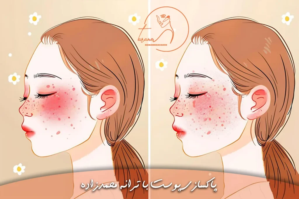 معرفی انواع اسکار در آکادمی پوست ترانه محمدزاده