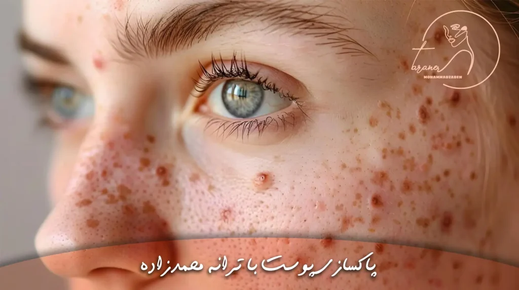 معرفی انواع مدل های جوش در اکادمی پوست ترانه محمدزاده