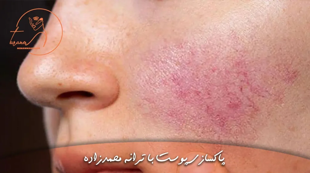 روزاسه یا رزاسه چیست؟ آکادمی پوست ترانه محمدزاده