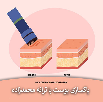 نحوه کار میکرونیدلینگ در رفه جای جوش و زخم. ترانه محمزاده