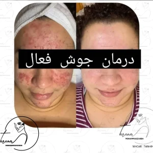 درمان جوش فعال توسط ترانه محمدزاده در پاکسازی پوست